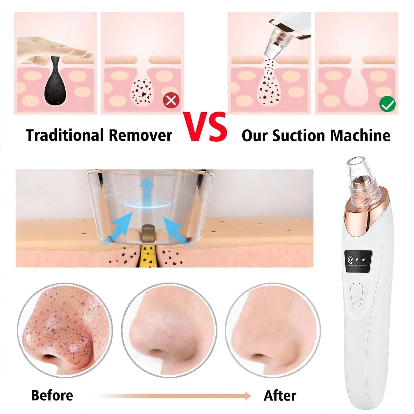 Electric Blackhead Remover – Vacuum Pore Cleaner with 5 Heads